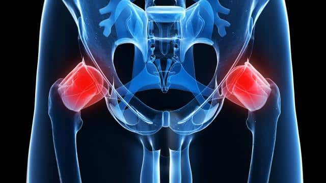Vondt i hoften (Hoftesmerter) - Årsaker, diagnose, behandling og øvelser +