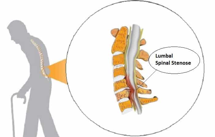 Lumbal spinal stenose