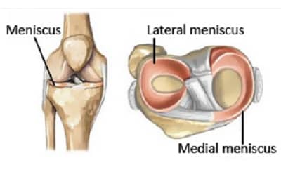 Ruperea meniscului (leziunea meniscului) | Simptome, tratament, exerciții,  sfaturi și sfaturi.