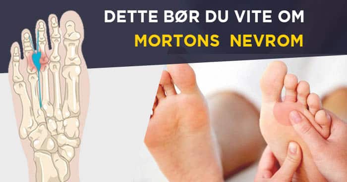 Mortons neuroma - symptomer, årsag, diagnose og behandling.