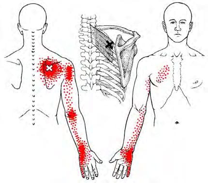 rhomboideus triggerpunkt