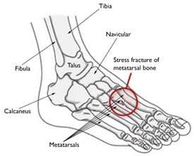 Stressbrudd i foten. Diagnostisering, årsak og behandling.