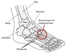 Pirštų skausmas (kojų piršto skausmas) - Priežastis, diagnozė, priemonės,  pratybos ir gydymas +