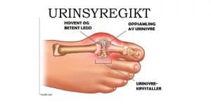urinsyregikt for facebook post 2