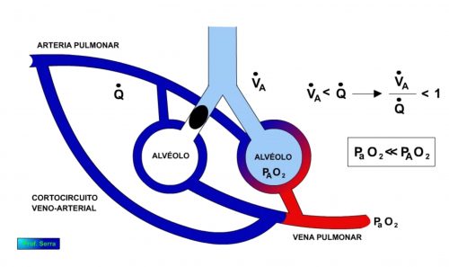 derivación arterio venosa