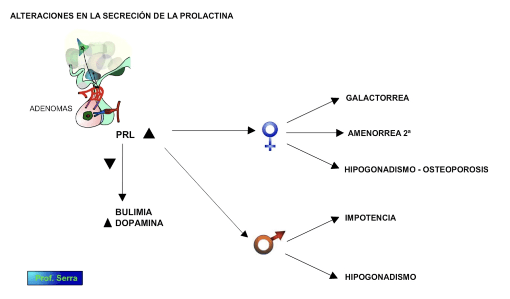 alteraciones prolactina