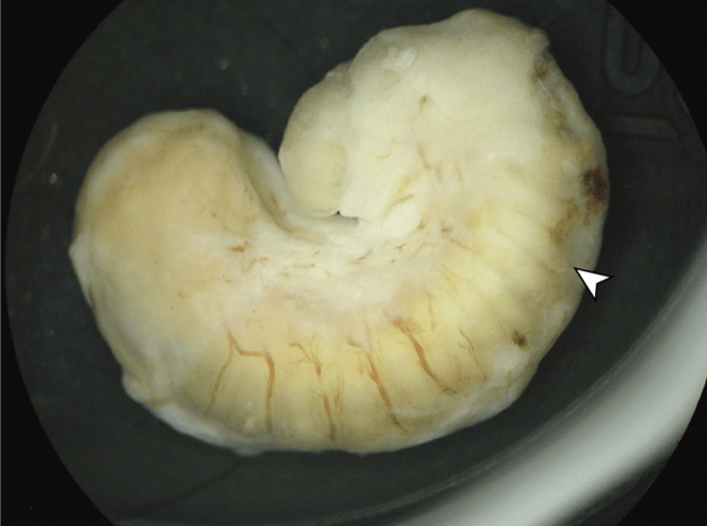 The larva which had been growing in a woman's eye