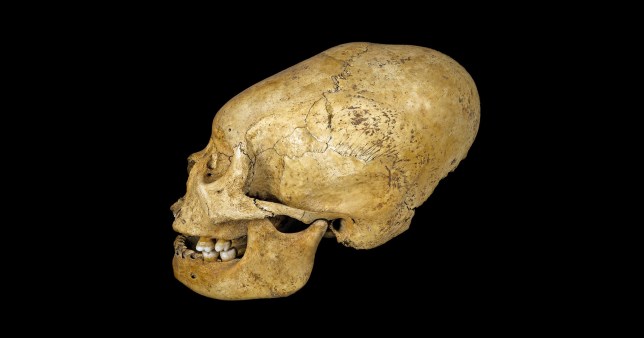 A skull that has been artificially deformed