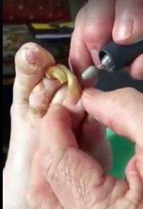 fungal-toenail-infection-gross