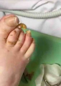 fungal-toenail-infection-sick