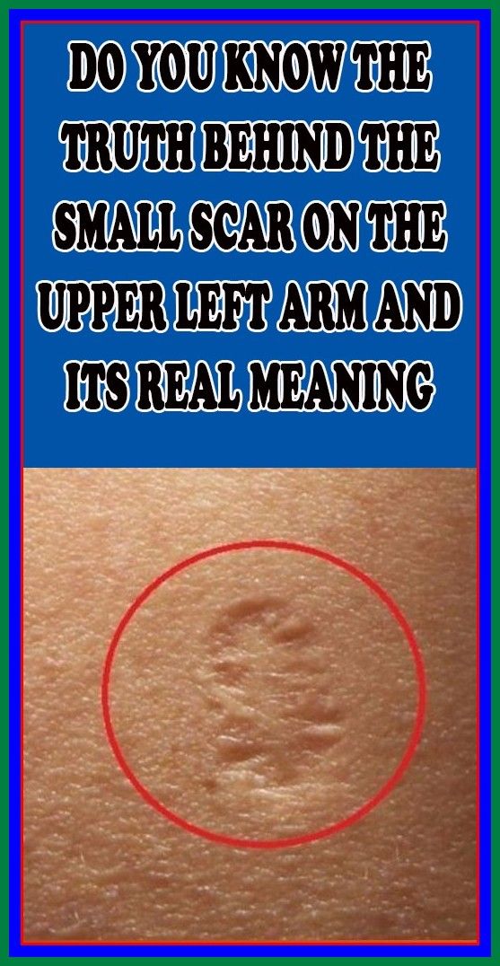 Do You Know The Truth Behind The Small Scar On The Upper Left Arm And Its Real Meaning