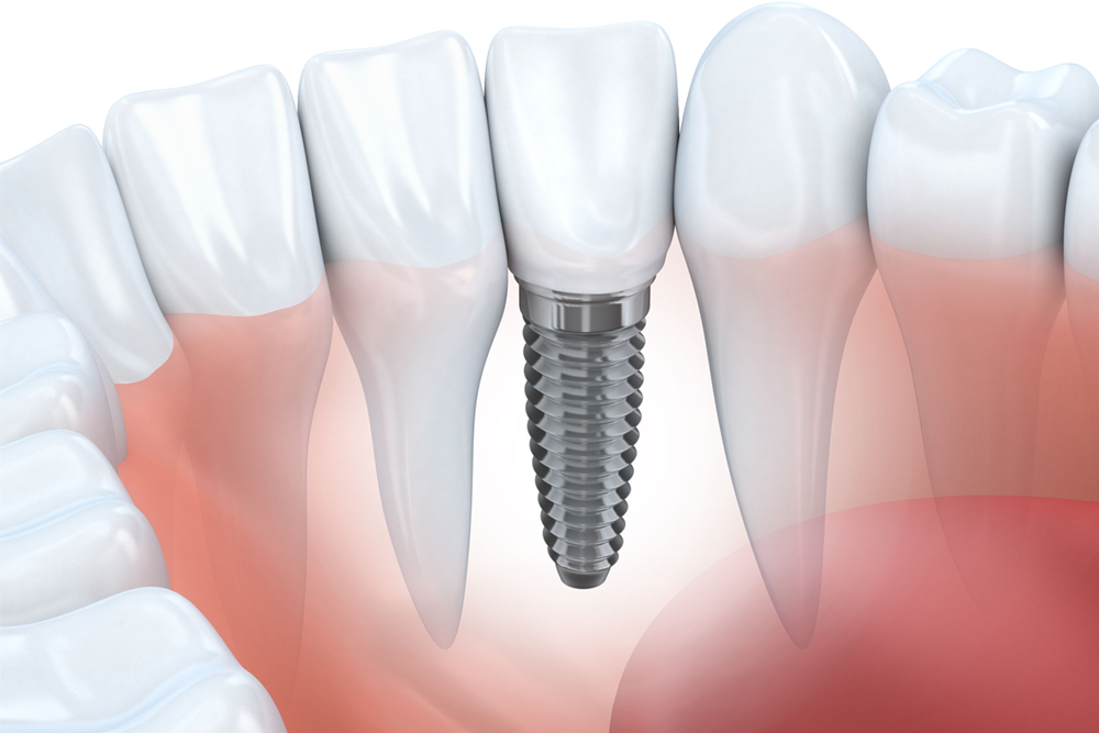 Zahnimplantat sicher und günstig