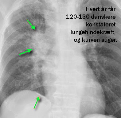 Asbest-kræft