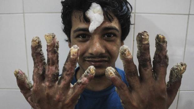 El «hombre árbol» de Bangladesh se siente «genial» con sus nuevas manos