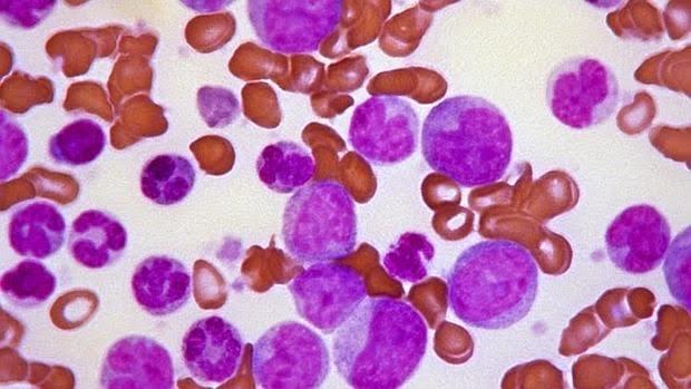 Identificada una nueva diana terapéutica para prevenir o frenar la leucemia