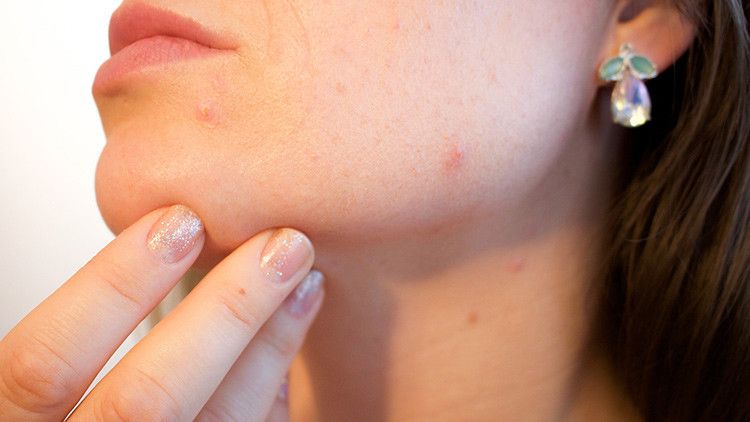 El acné podría tener una ventaja sorprendente para los que lo sufren – RT