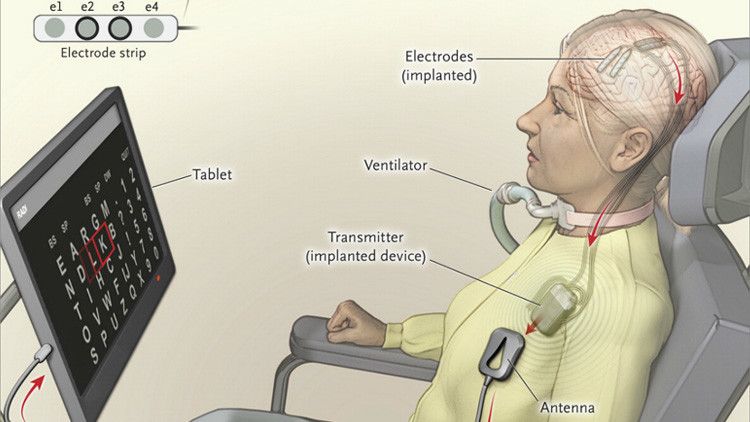 Hablando con la mente: Un implante en el cerebro permite comunicarse a una mujer con parálisis – RT